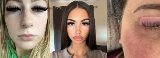 Why Women Are Falling Victim to Eyelash Blindness